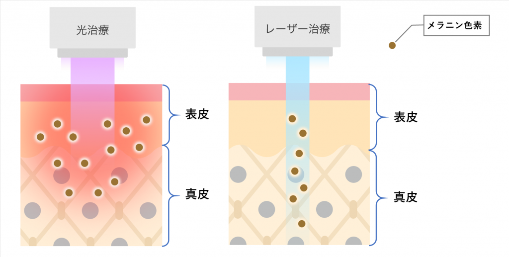 光治療とレーザー治療の構造